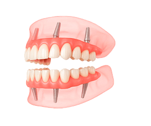 Имплантация зубов